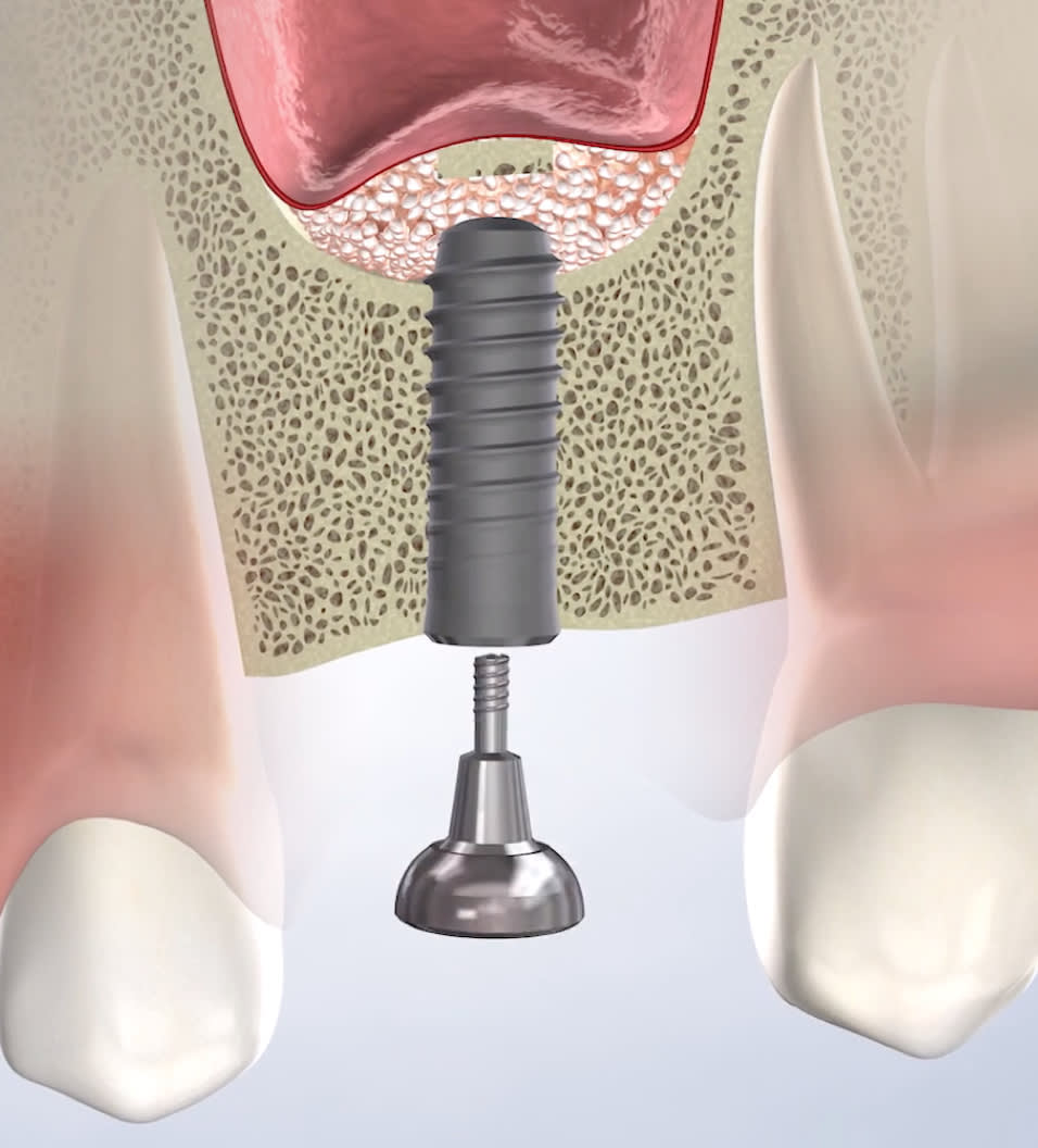 query  bone grafting