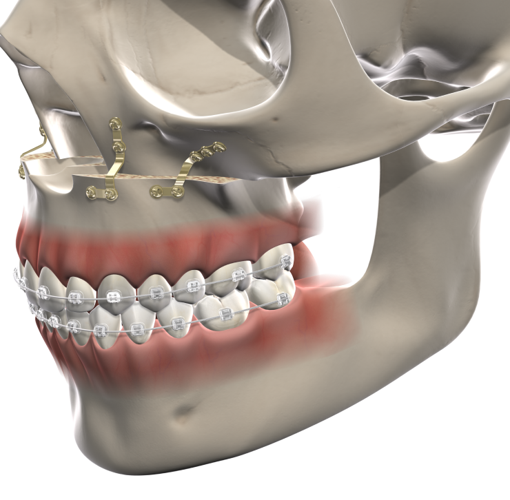 Isolated Facial TraumaFacial Trauma mobile