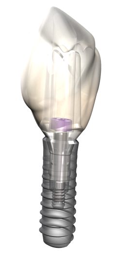 Isolated dental implant