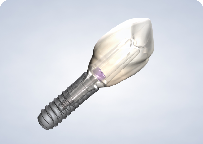 Home Dental Implants